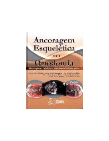 Livro, Ancoragem Esquelética em Ortodontia Mini-Implante Minip 2/13[LS]